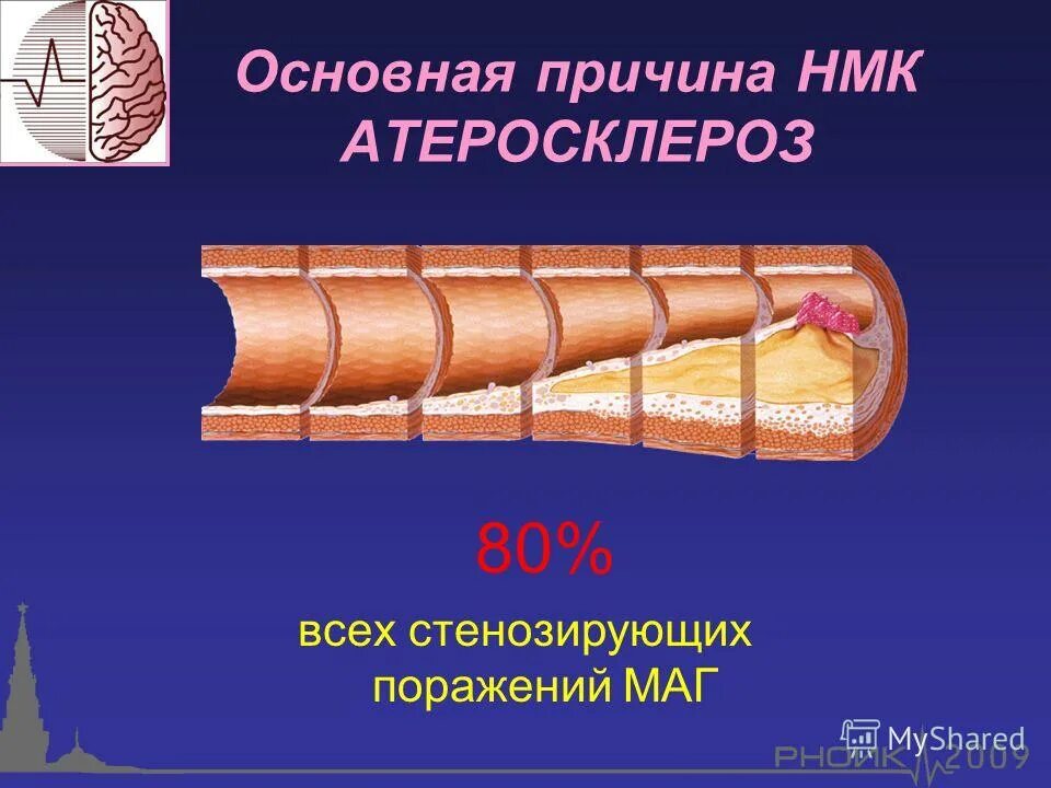 Стенозирующий атеросклероз код. Хроническая ишемия головного мозга мкб 10. Цереброваскулярная болезнь код мкб. Атеросклероз сосудов головного мозга формулировка диагноза. Стенозирующий атеросклероз код.