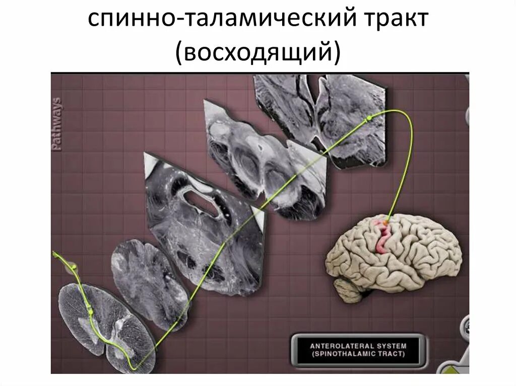 Спинно таламический тракт. Спинно таламический путь. Спинно-цервикальный тракт. Латеральный тракт Морина.