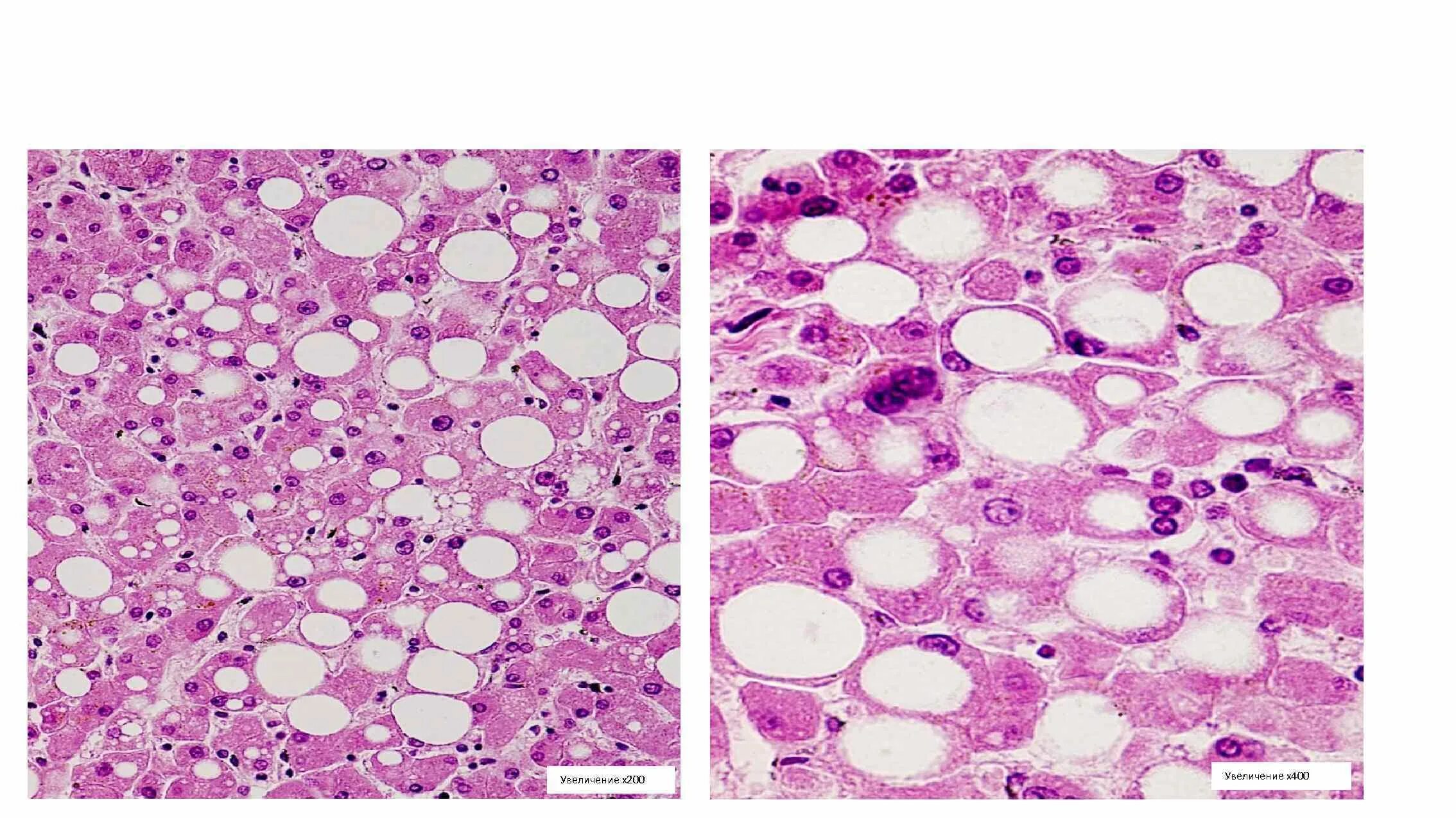 Токсическая дистрофия печени. Паренхиматозная жировая дистрофия печени микропрепарат. Жировая дистрофия печени микропрепарат. Острый жировой гепатоз гистология. Жировая дистрофия печени гистология.