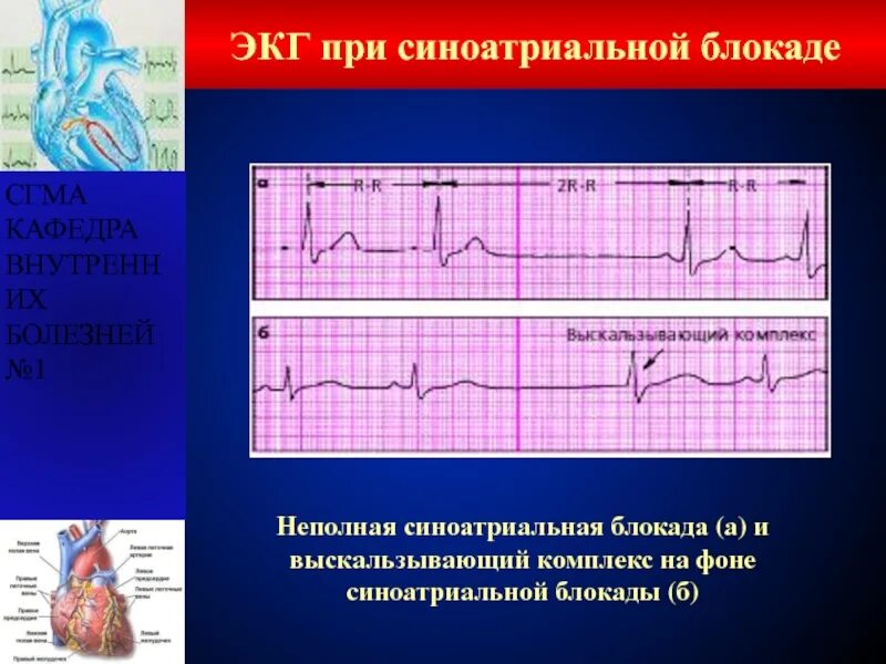 Комплекс блокада. Синоатриальная блокада 2 степени на ЭКГ. ЭКГ при синоатриальной блокаде 2 степени Тип 1. ЭКГ признаки синоатриальной блокады. ЭКГ критерии синоатриальной блокады.