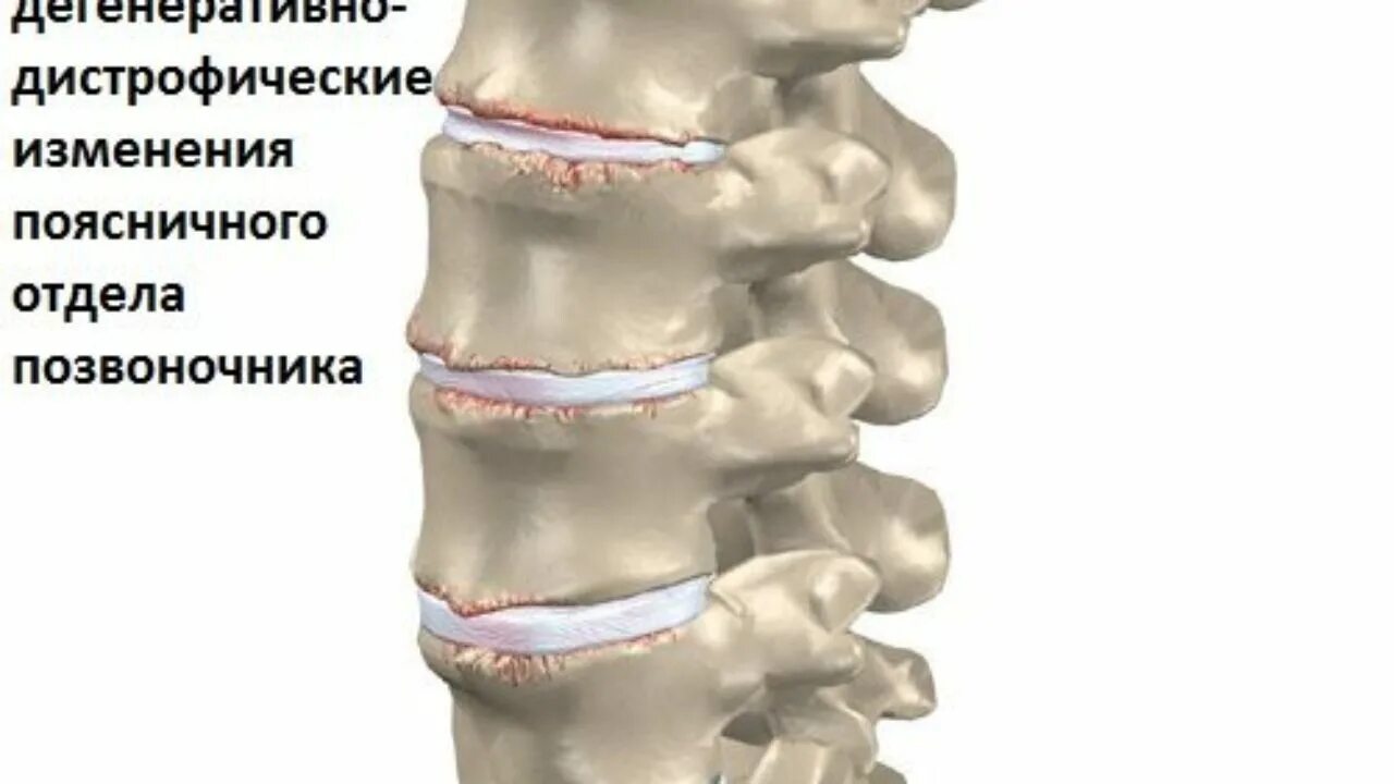 Дегенеративно-дистрофические изменения позвоночника что это. Остеохондроз поясничного отдела позвонка. Остеохондроз пояснично-крестцового отдела позвоночника 2 степени. Спондилоартроз пояснично-крестцового отдела позвоночника.