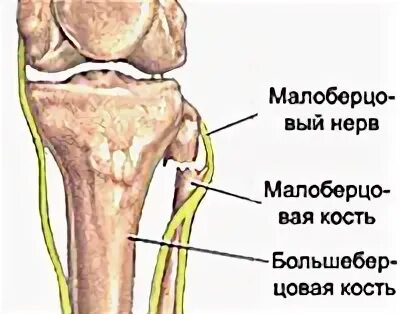 Невропатия малоберцового нерва. Невропатия (неврит) малоберцового нерва. Нейропатии большеберцового малоберцового нерва. Нейропатия малоберцового нерва анатомия. Большеберцовая нейропатия