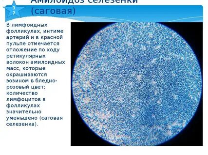 Саговый амилоидоз селезенки