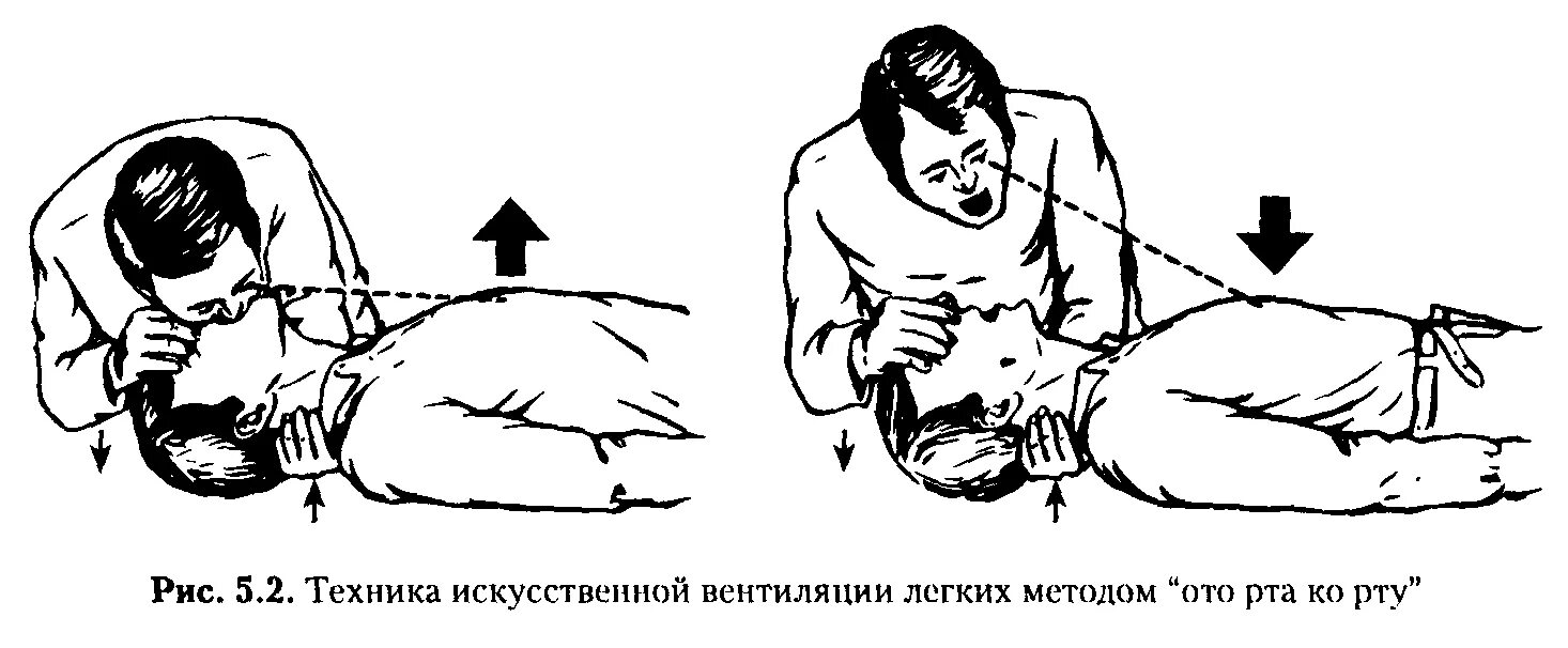 Типов искусственной вентиляции легких. Слр искусственная вентиляция легких.