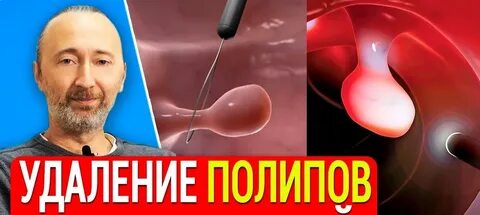 Лечение полипа без операции отзывы