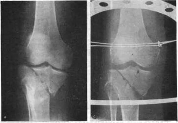 Импрессионный перелом мыщелка. Переломы большеберцовой кости коленный. Большеберцовая кость мыщелка. Перелом мыщелка бедренной кости.