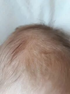 Сухая кожа 5 месяцев