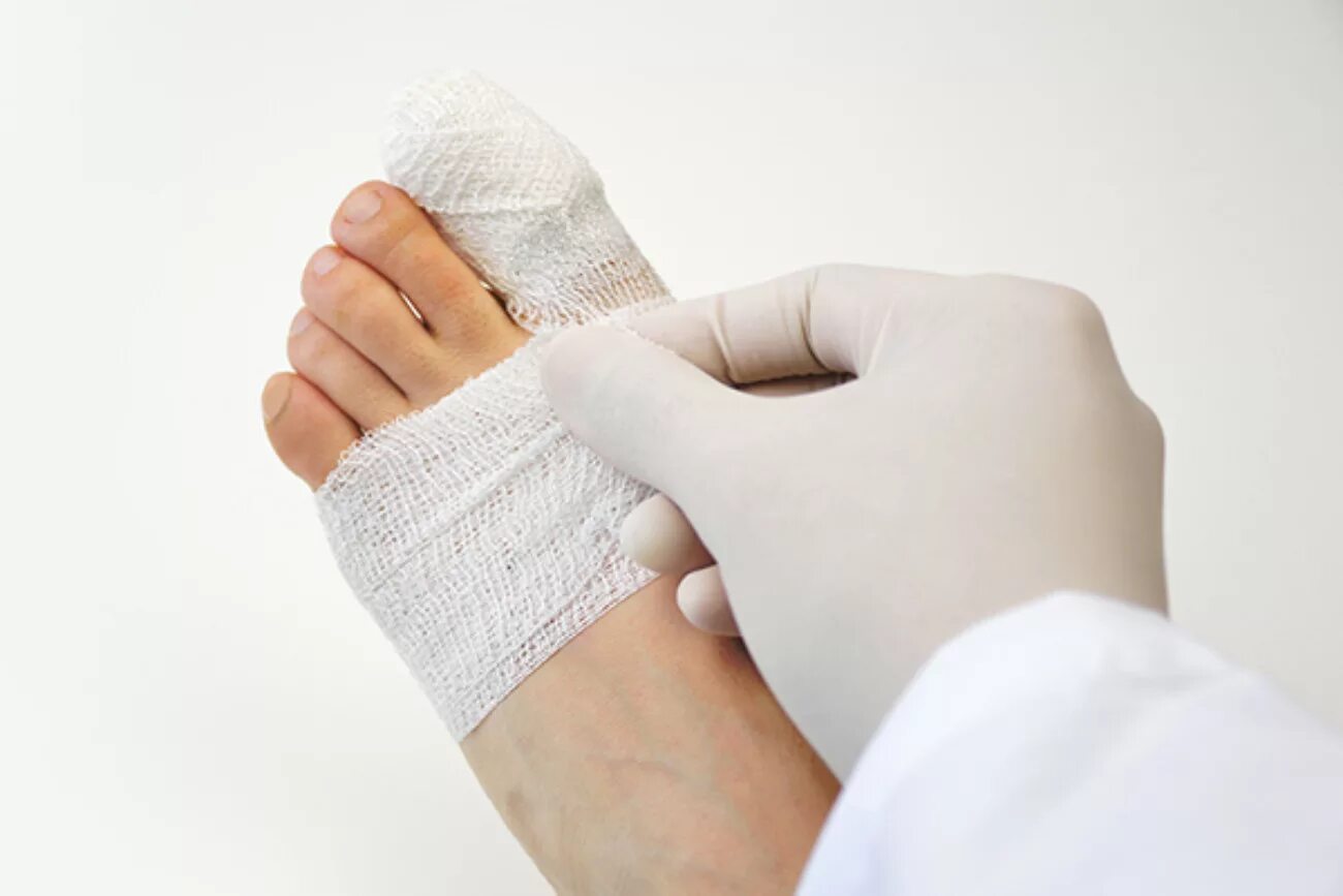 перелом большого пальца натноге. если на ноге сломан палец гипс накладывают. если на ноге сломан палец гипс накладывают. гипсовая лонгетка гипс. гипс при переломе большого пальца ноги.