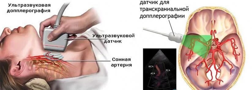 Бца что это такое в медицине. Ультразвуковая допплерография сосудов головного мозга. УЗДГ бца сосудов головы. Брахиоцефальные артерии УЗИ. УЗИ сосудов брахиоцефального ствола.