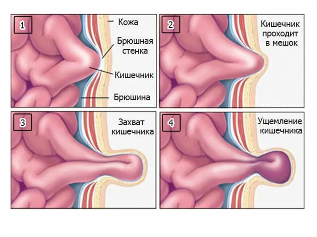Ущемленная брюшной грыжа. Ущемленная пупочная грыжа.