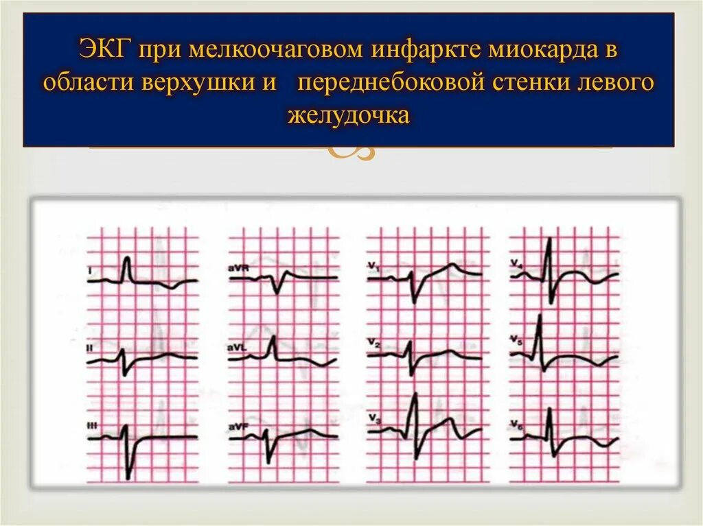 Инфаркт миокарда передней стенки ЭКГ. ЭКГ при инфаркте миокарда левого желудочка. Острый передний инфаркт миокарда на ЭКГ. ЭКГ при инфаркте переднебоковой. Изменение боковой стенки левого желудочка