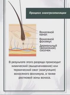 Процедура электроэпиляции