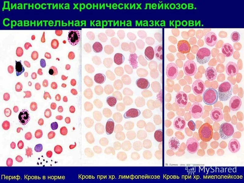 Острый лейкоз мазок крови. Острый миелобластный лейкоз мазок. Хронический лейкоз мазок крови. Картина крови хронического миелолейкоза. Хронический лимфолейкоз рекомендации