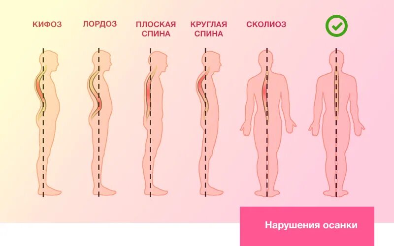 Нарушение осанки относится к. Нарушение осанки. дефекты осанки. типы искривления осанки. формы нарушения осанки.