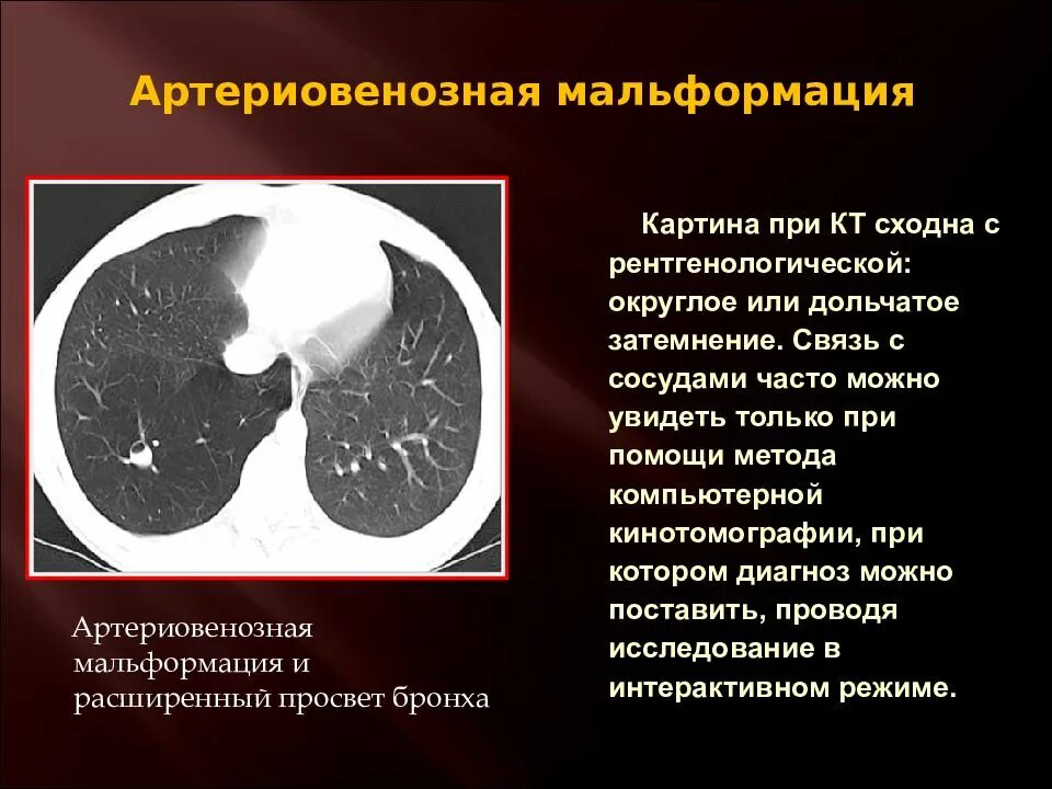 Сосудистая аномалия. Артериовенозная мальформация в легких на кт. Артериовенозные шунты кт. Артериовенозные аневризмы легких кт. Сосудистая мальформация легких на кт.