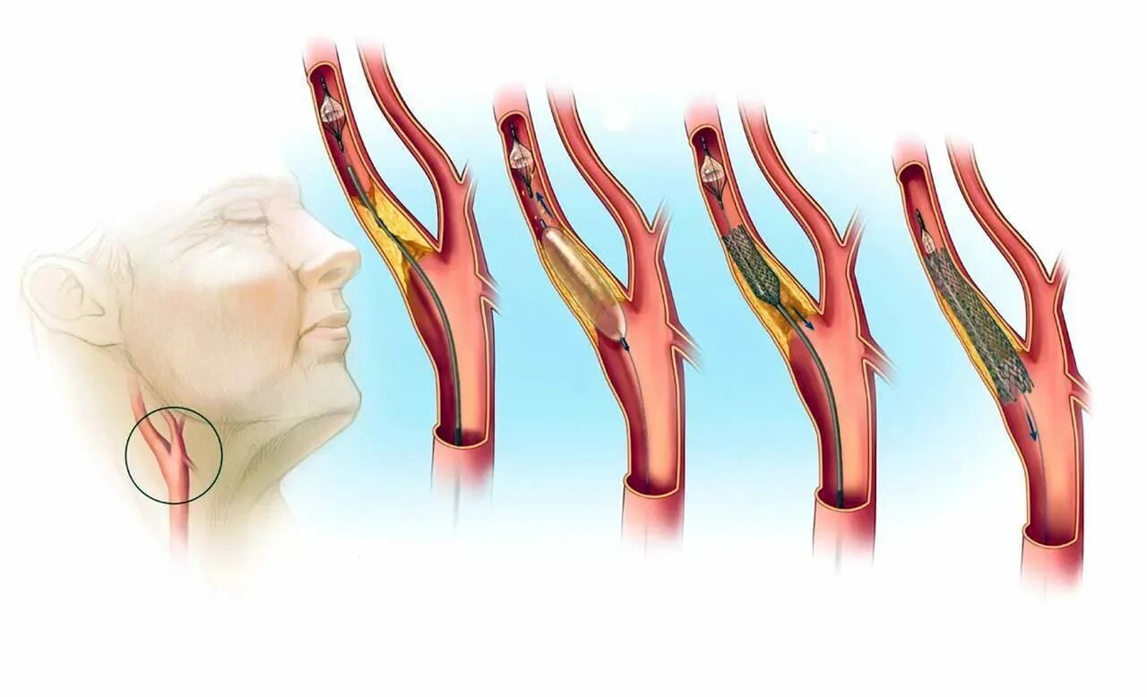 Стентирование шейных артерий. Стентирование брахиоцефального ствола. Стентирование сосудов сонной артерии. Атеросклероз сосудов шеи сонных артерий. Сужение сосудов симптомы лечение