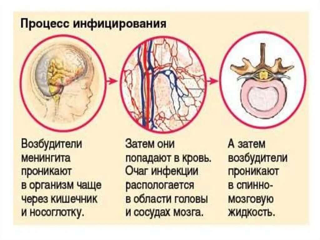 Воспаление серозной оболочки. Вирусный менингит симптомы. Серозный вирусный менингит. Серозный вирусный менингит у детей.