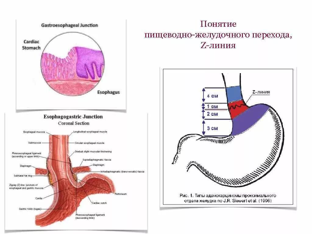 Кардиальный отдел пищевода. Анатомия пищеводно-желудочного соединения. Кардиоэзофагеальный отдел желудка. Зубчатая линия пищевода.