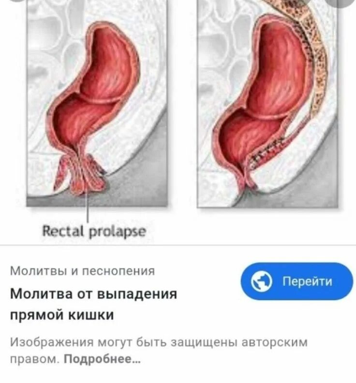 Может ли вылезти кишка. Молитва от выпадения прямой кишки. прямая кишка выпадение.