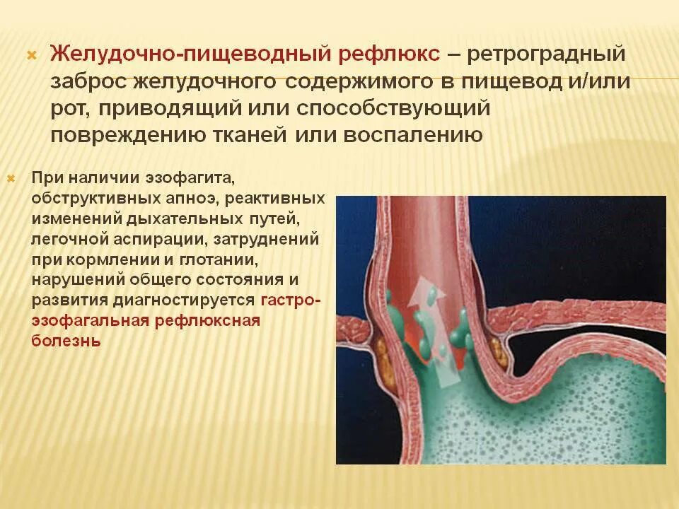 Раздражает пищевод. Синдром желудочно-пищеводного рефлюкса. Гастроэзофагеальная гастроэзофагеальный рефлюкс. Гастроэзофагеальная рефлюксная болезнь.