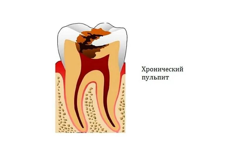 Фиброзный периодонтит. Хронический фиброзный пульпит пульпит. Пульпит хронич.фиброзный что это?. Пульпит кариозная полость. Хронический фиброзный пульпит рисунок.