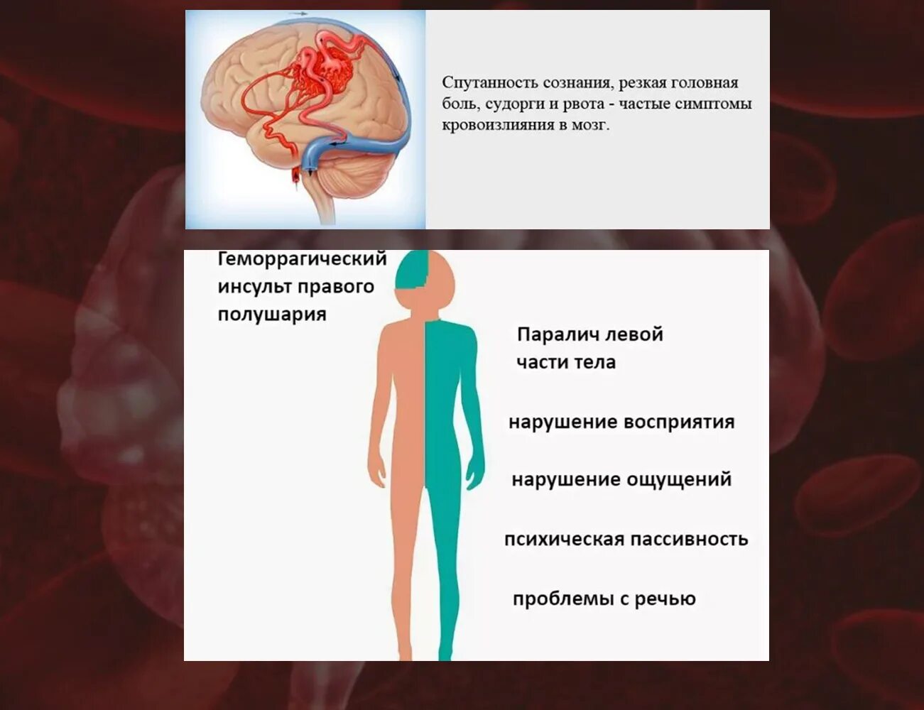 Инсульт правая сторона мозга последствия. Геморрагический инсульт симптомы. Геморрагический инсульт проявления. Мозговое кровоизлияние симптомы. Признаки геморрагического инсульта.