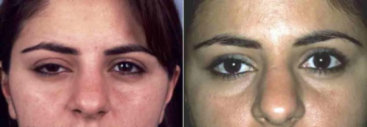 Isolated Nuclear Oculomotor Nerve Palsy