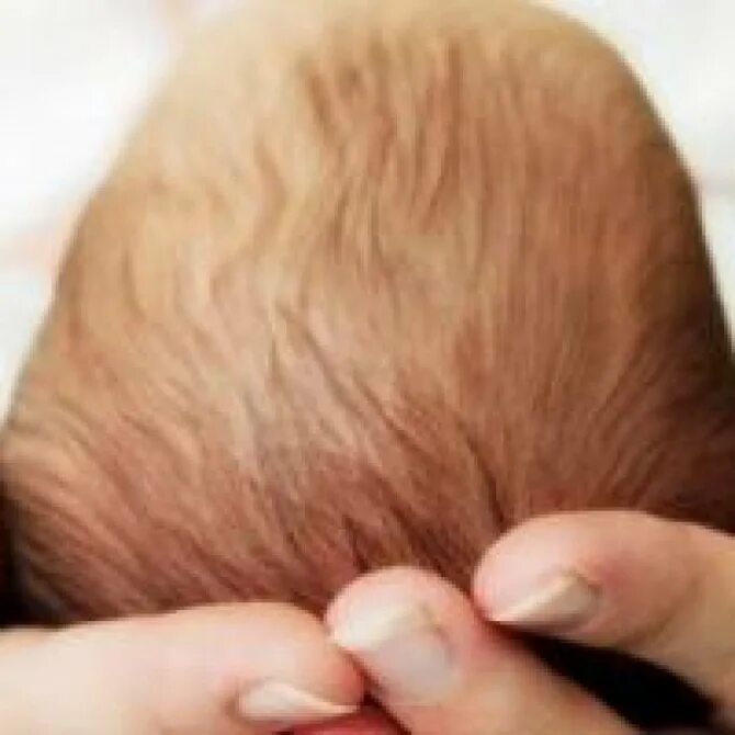 Корочки на голове у новорожденного. Родничок на голове у новорожденного.