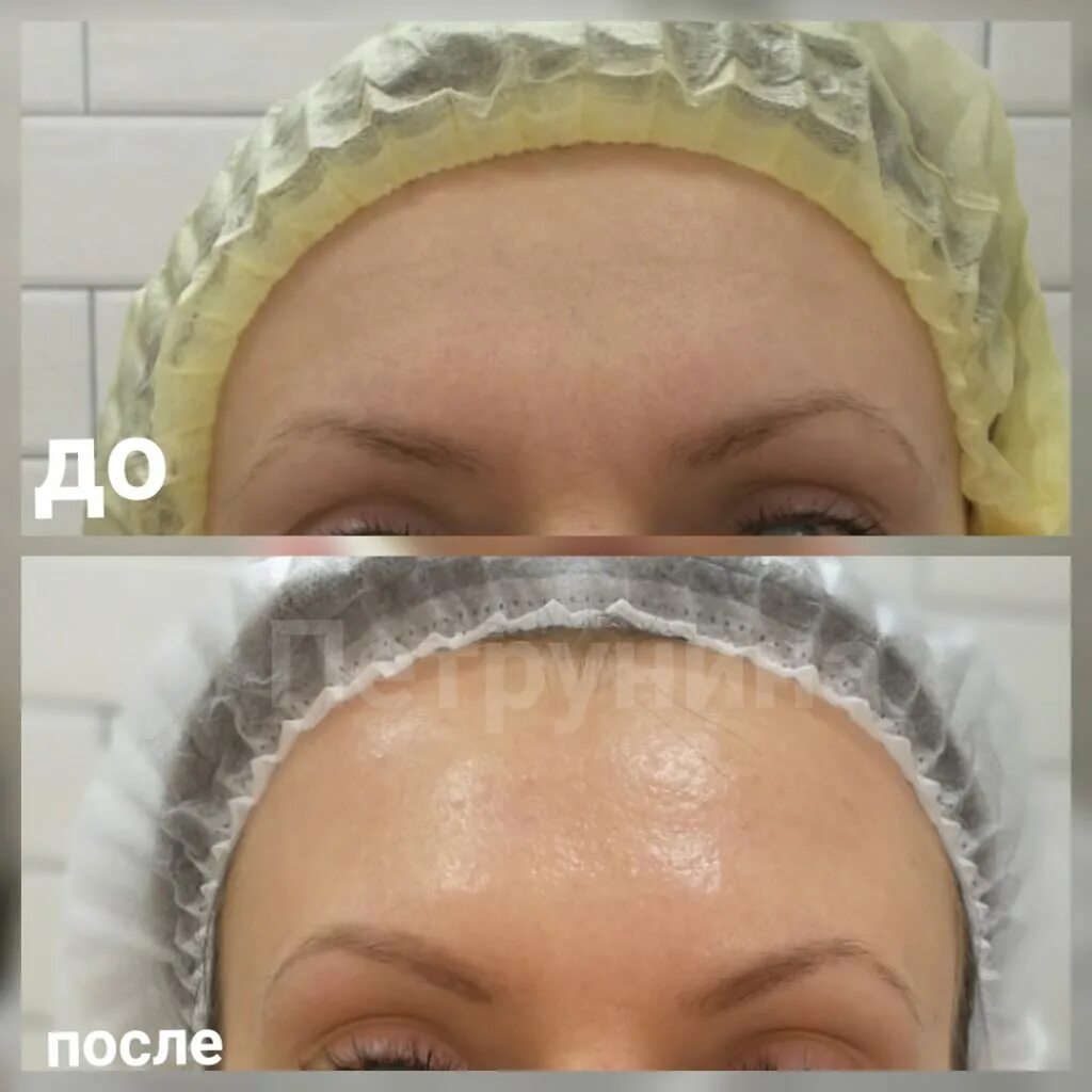 Ботулинотерапия результаты. Ботулинотерапия результаты