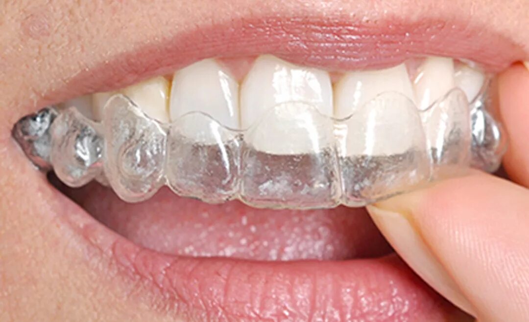 Каппы инвизилайн. Ортодонт каппы элайнеры. Капа инвизилайн ортодонтическая инвизилайн. Лайнеры зубные. Ортодонт каппы элайнеры.