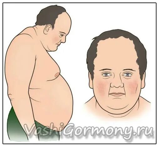 Кортизоловый живот как выглядит. Люди с повышенным кортизолом. кортизоловый животик у мужчин. кортизоловое ожирение у мужчин. кортизоловое телосложение.