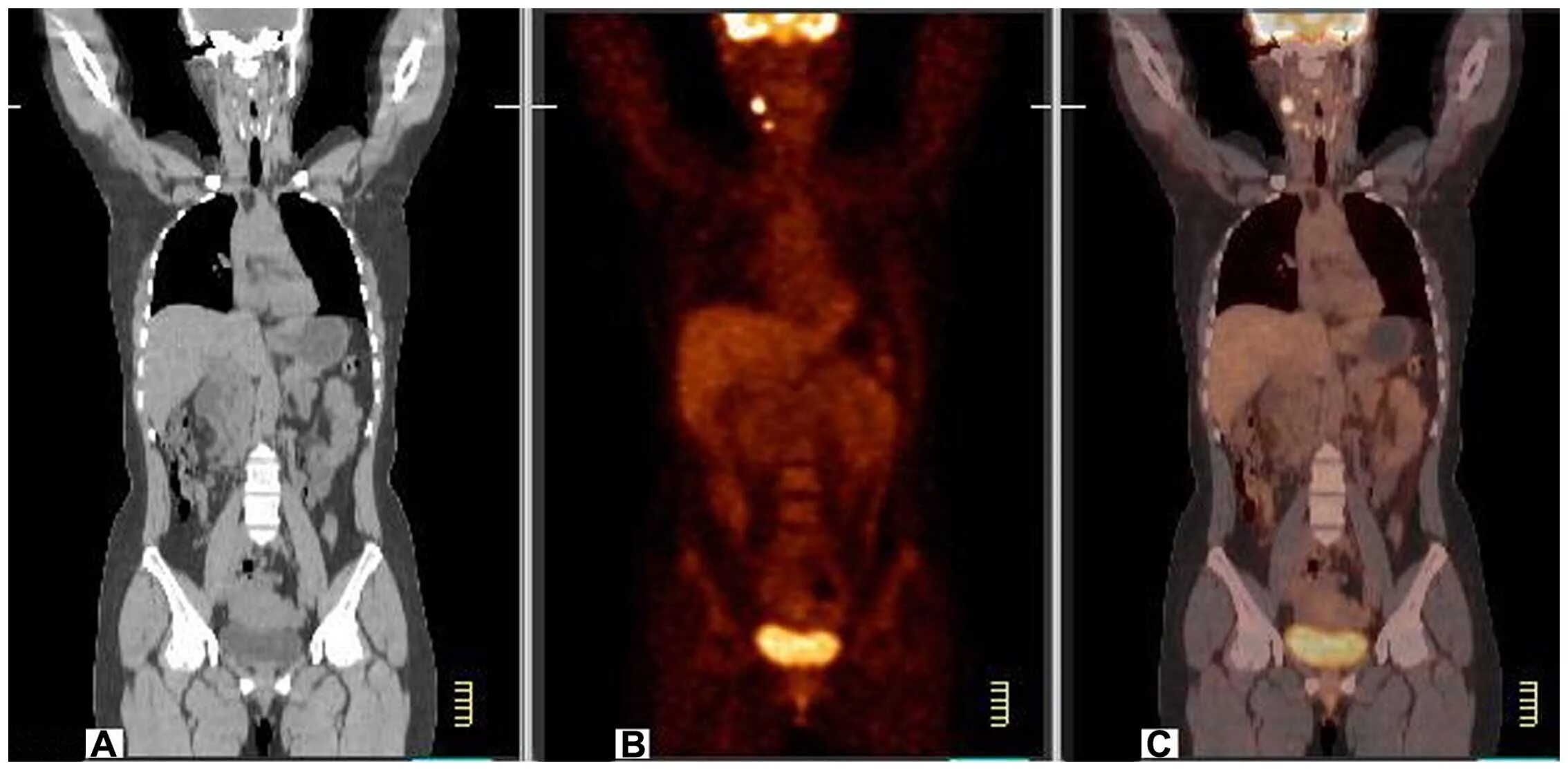 Positron emission tomography (Pet) scans. ПЭТ кт Pet CT. Что можно перед пэт кт с контрастом