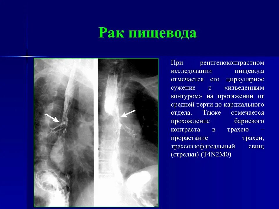 Лучевая пищевода