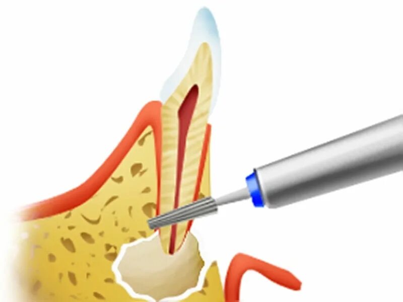 Зубосохраняющие операции (резекция верхушки корня. Цистэктомия с резекцией верхушки корня. Резекция верхушки корня одного зуба. Показания к резекции верхушки корня. Цистоэктомия
