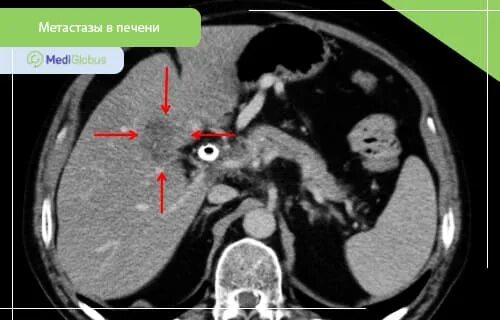 Гиперваскулярные метастазы печени кт. Метастазы в печени на ПЭТ кт. Вылечить метастазы в печени