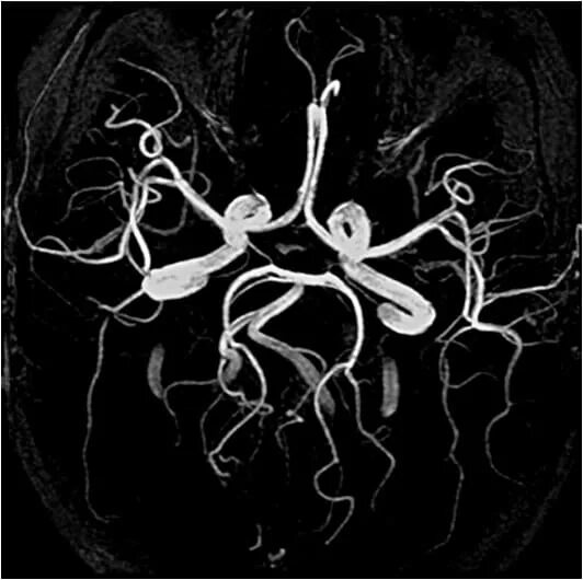 мрт ангиограмма сосудов головного мозга. мрт сосудов тамбов. мрт ангиограмма сосудов головного мозга. впр сосудов головного мозга. Neusoft medical.