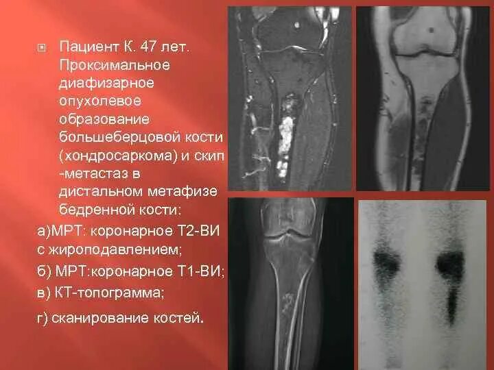 Метастазы костей мрт. Хондросаркома большеберцовой кости мрт. костная киста метафиза бедренной кости. метафиза большеберцовой кости. образование большеберцовой кости.