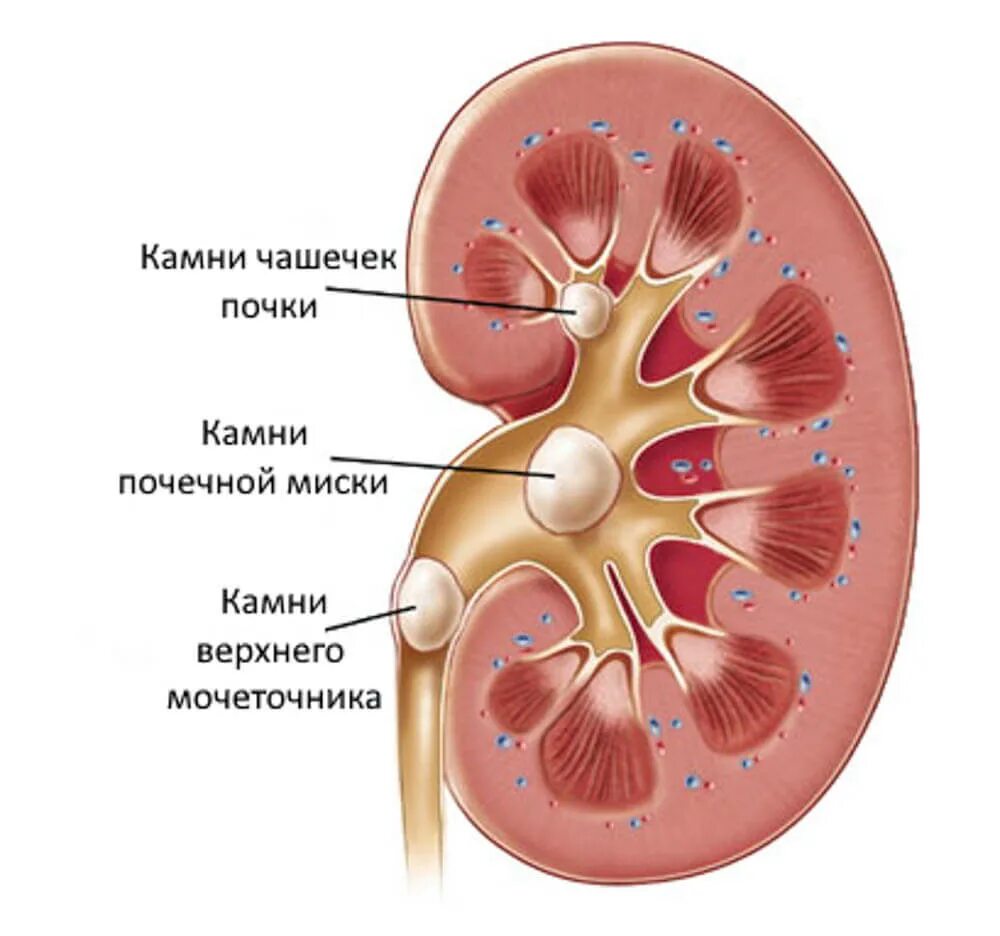 Камни в почках заболевание. Мочекаменная и Почечнокаменная болезнь. Мочекаменная болезнь почек. Мочекаменная болезнь конкременты. Мочекаменная болезнь образование камней.