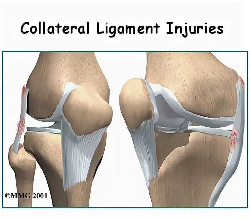 Лигаментита связок коленного. Медиальная коллатеральная связка коленного сустава. Разрыв связок коленного сустава. Медиальная коллатеральная связка коленного сустава повреждение. Операция на крестообразной связки коленного сустава.