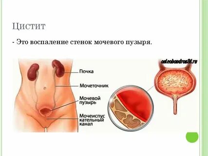 Гнойный цистит