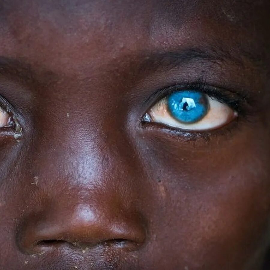 Глаза темнокожих. Синдром Ваарденбурга глаза. Необычный цвет глаз. Самый необычный цвет глаз. Необычные глаза у людей.