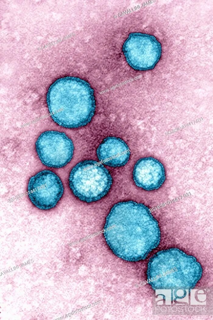 Syncytial virus. Респираторно-синцитиальная инфекция. Рино синцитиальный вирус. Бронхиолит респираторный синцитиальный вирус. Респираторно-синцитиальной инфекции КРС.