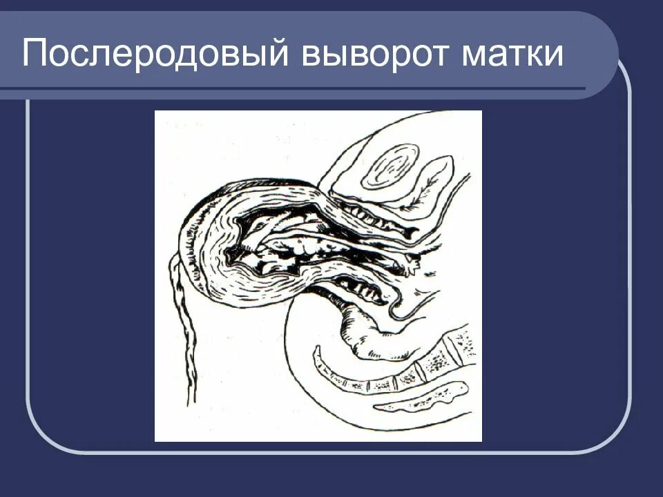 Почему опускается матка. Послеродовый выворот матки. Вправление выворота матки. Выворот и выпадение матки.