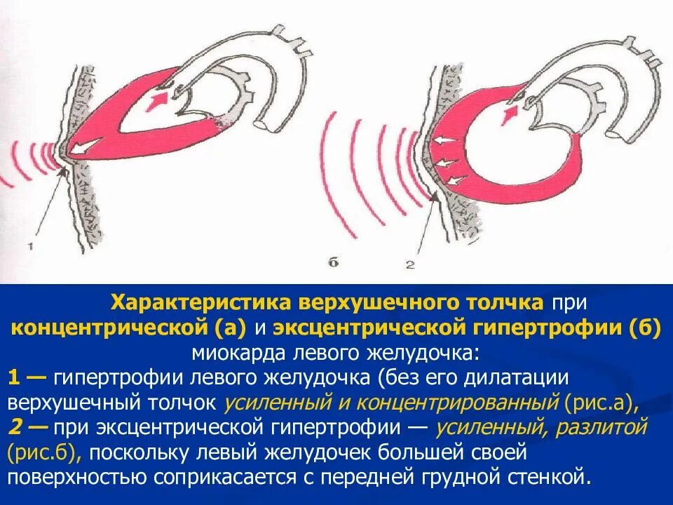 Верхушечный толчок при гипертрофии. Концентрическая и эксцентрическая гипертрофия. концентрическая гипертрофия лж. верхушечный толчок при гипертрофии левого желудочка. усиление верхушечного толчка.
