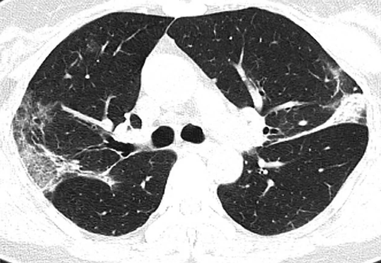 Кт 4 легкие. Вирусная пневмония на кт. Кт-4 пневмония. Коронавирус пневмония рентген. Ковидная пневмония на кт.