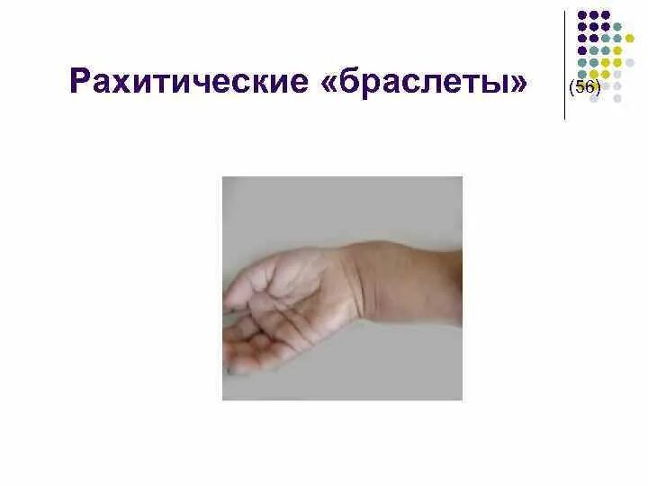Проявление спазмофилии