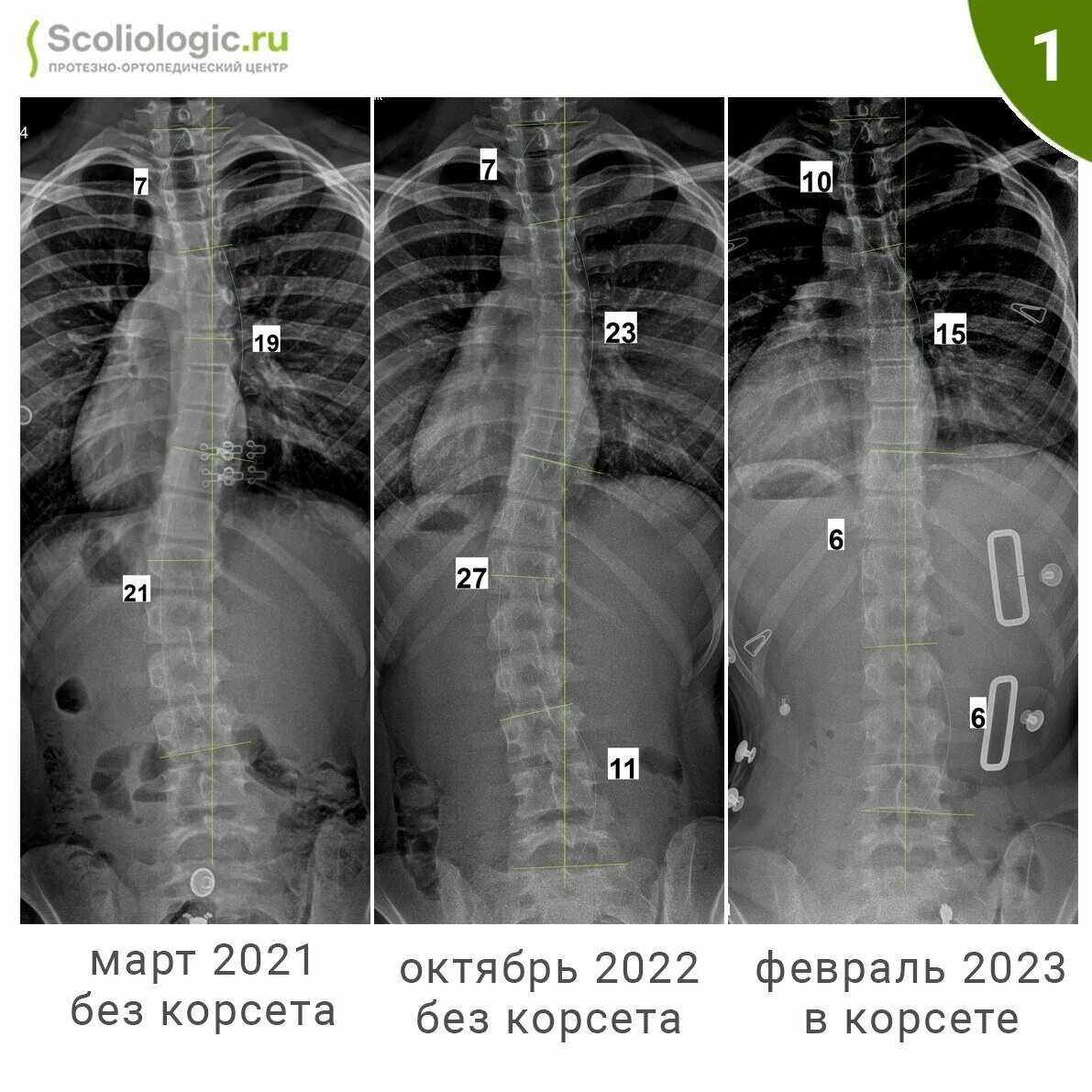 Можно вылечить сколиоз 2 степени. Дегенеративного сколиоза ii степени. сколиоз 2 степени лечится. сколиоз 2 степени картинки. сколиоз 2 степени 11 градусов.