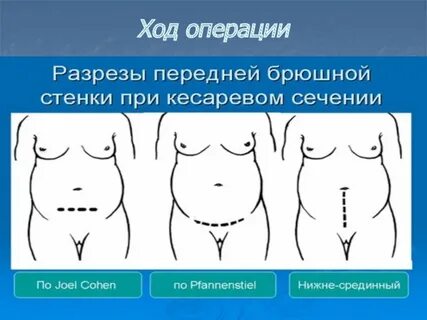 Можно ли кесарево сечение