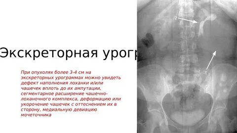 Опухоль почки мочевого пузыря