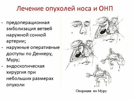 Доброкачественные опухоли пазух носа